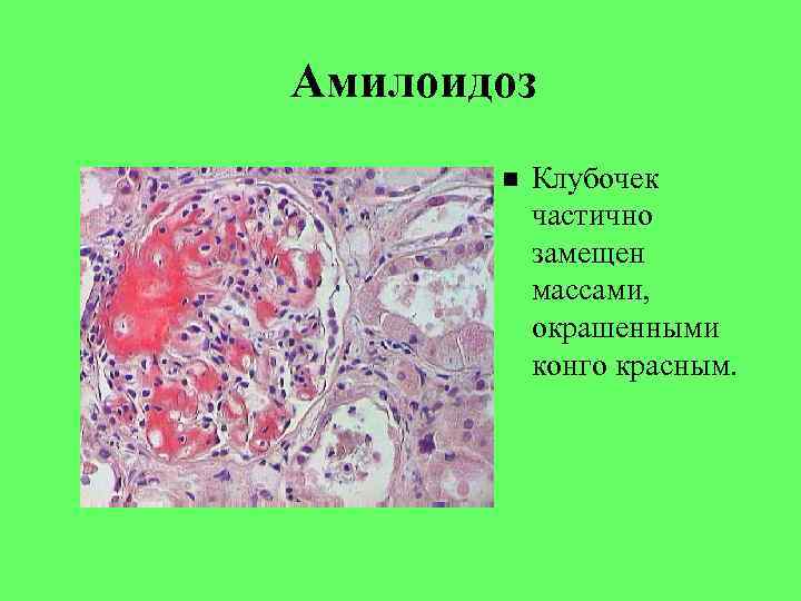 Амилоидоз презентация патанатомия