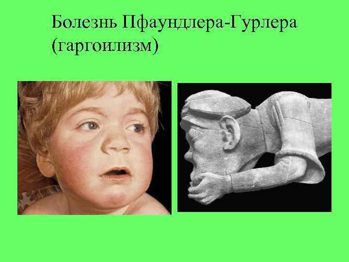 Болезнь Пфаундлера-Гурлера (гаргоилизм) 