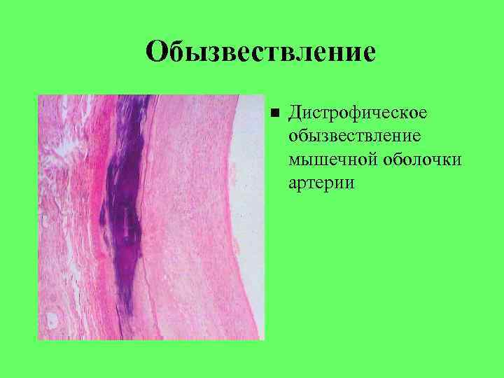 Обызвествление Дистрофическое обызвествление мышечной оболочки артерии 