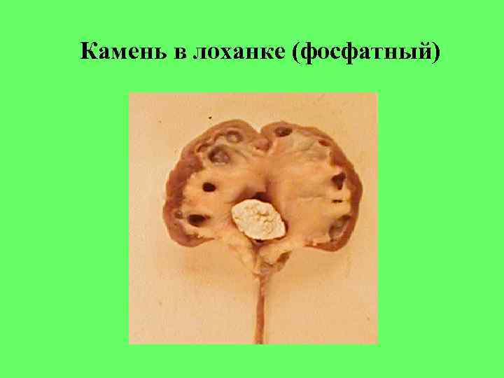 Камень в лоханке (фосфатный) 
