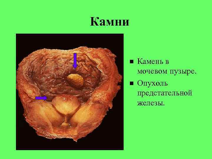 Камни Камень в мочевом пузыре. Опухоль предстательной железы. 