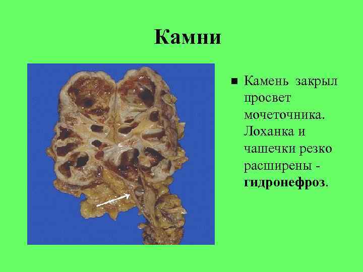 Камни Камень закрыл просвет мочеточника. Лоханка и чашечки резко расширены гидронефроз. 