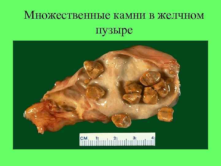 Множественные камни в желчном пузыре 
