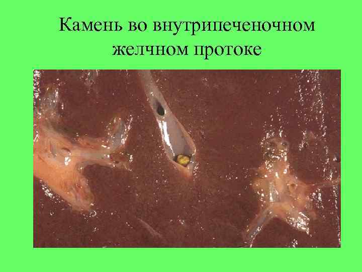 Камень во внутрипеченочном желчном протоке Камень в просвктк мочевого пузыря 