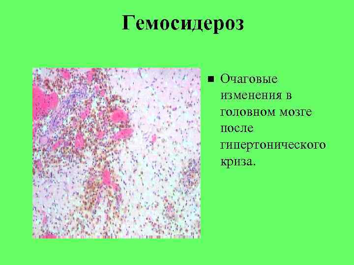 Гемосидероз Очаговые изменения в головном мозге после гипертонического криза. 