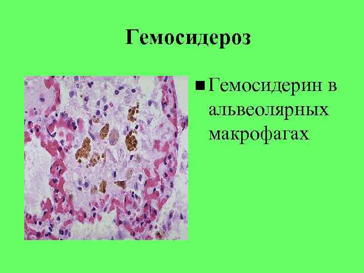 Гемосидероз Гемосидерин в альвеолярных макрофагах 
