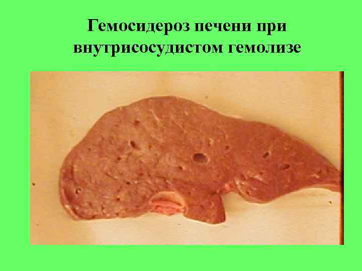 Гемосидероз печени при внутрисосудистом гемолизе 