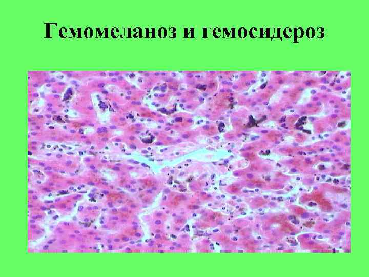 Гемомеланоз и гемосидероз 