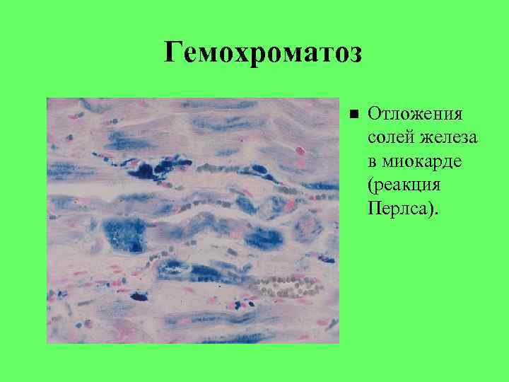 Гемохроматоз Отложения солей железа в миокарде (реакция Перлса). 