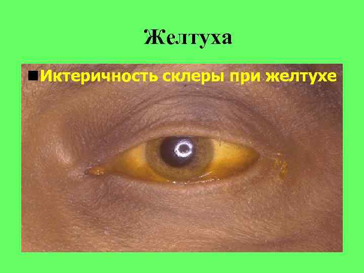 Желтуха Иктеричность склеры при желтухе 