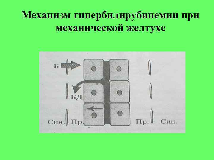 Механизм гипербилирубинемии при механической желтухе 