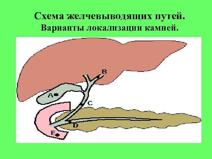 Схема желчевыводящих путей. Варианты локализации камней. 