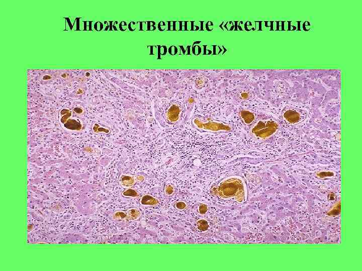 Множественные «желчные тромбы» 