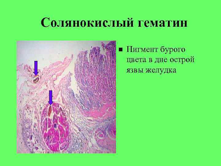 Солянокислый гематин Пигмент бурого цвета в дне острой язвы желудка 