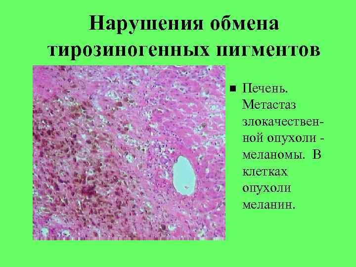 Нарушения обмена тирозиногенных пигментов Печень. Метастаз злокачественной опухоли меланомы. В клетках опухоли меланин. 
