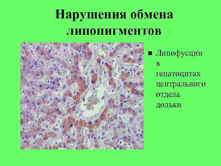 Нарушения обмена липопигментов Липофусцин в гепатоцитах центрального отдела дольки 