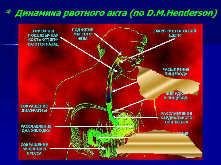 * Динамика рвотного акта (по D. M. Henderson) ГОРТАНЬ И ПОДЪЯЗЫЧНАЯ КОСТЬ ОТТЯГИВАЮТСЯ НАЗАД