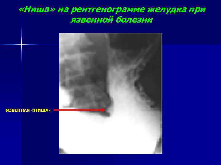  «Ниша» на рентгенограмме желудка при язвенной болезни ЯЗВЕННАЯ «НИША» 