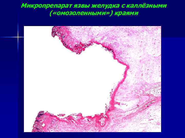 Микропрепарат язвы желудка с каллёзными ( «омозоленными» ) краями 
