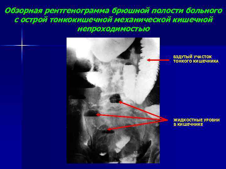 Обзорная рентгенограмма брюшной полости больного с острой тонкокишечной механической кишечной непроходимостью ВЗДУТЫЙ УЧАСТОК ТОНКОГО