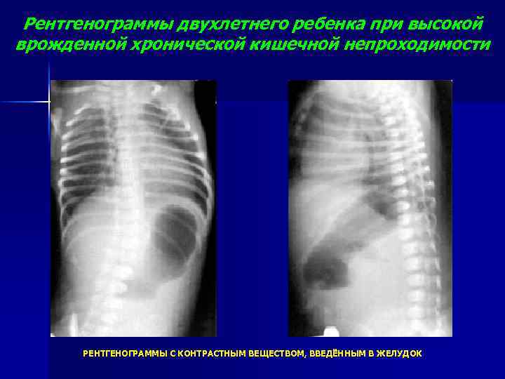 Рентгенограммы двухлетнего ребенка при высокой врожденной хронической кишечной непроходимости РЕНТГЕНОГРАММЫ С КОНТРАСТНЫМ ВЕЩЕСТВОМ, ВВЕДЁННЫМ