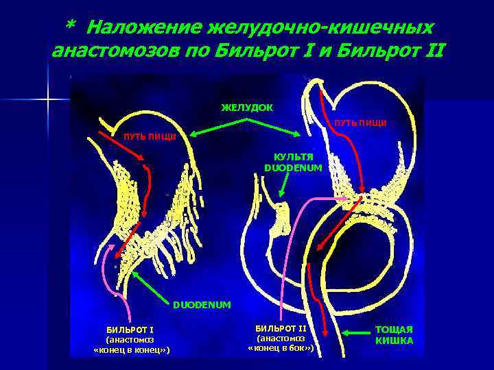 Кишечные анастомозы. Анастомоз конец в конец Бильрот. Наложения желудочно-кишечного соустья. Наложение желудочно-кишечного анастомоза.
