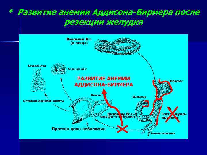 * Развитие анемии Аддисона-Бирмера после резекции желудка РАЗВИТИЕ АНЕМИИ АДДИСОНА-БИРМЕРА 