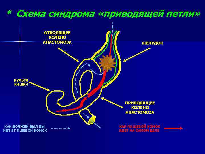 * Схема синдрома «приводящей петли» ОТВОДЯЩЕЕ КОЛЕНО АНАСТОМОЗА ЖЕЛУДОК КУЛЬТЯ КИШКИ ПРИВОДЯЩЕЕ КОЛЕНО АНАСТОМОЗА