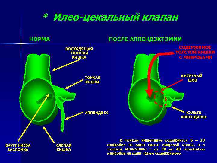 * Илео-цекальный клапан НОРМА ПОСЛЕ АППЕНДЭКТОМИИ СОДЕРЖИМОЕ ТОЛСТОЙ КИШКИ С МИКРОБАМИ ВОСХОДЯЩАЯ ТОЛСТАЯ КИШКА