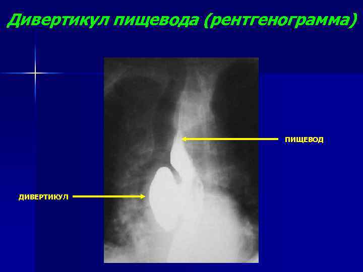 Дивертикул пищевода (рентгенограмма) ПИЩЕВОД ДИВЕРТИКУЛ 