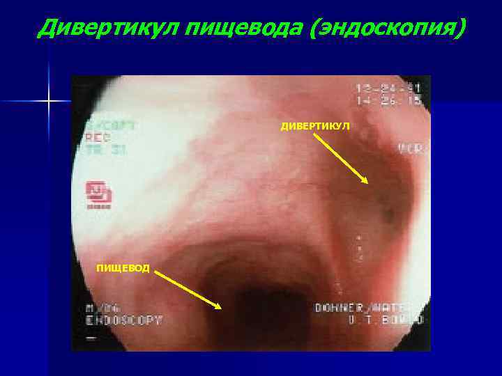 Дивертикул пищевода (эндоскопия) ДИВЕРТИКУЛ ПИЩЕВОД 