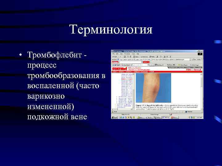 Посттромбофлебитический синдром презентация