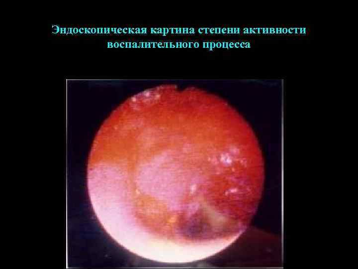 Эндоскопическая картина степени активности воспалительного процесса 