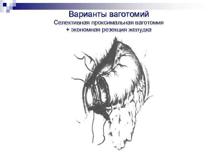 Варианты ваготомий Селективная проксимальная ваготомия + экономная резекция желудка 