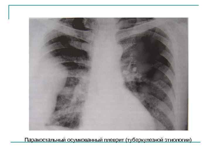 Паракостальный осумкованный плеврит (туберкулезной этиологии) 