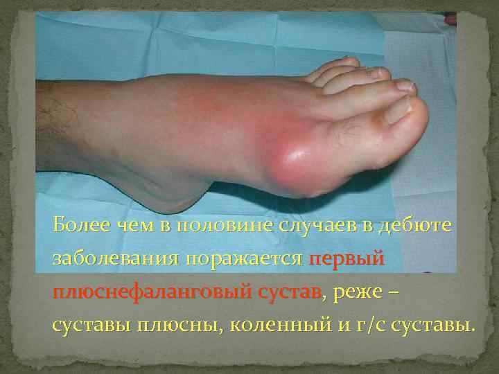 Более чем в половине случаев в дебюте заболевания поражается первый плюснефаланговый сустав, реже –