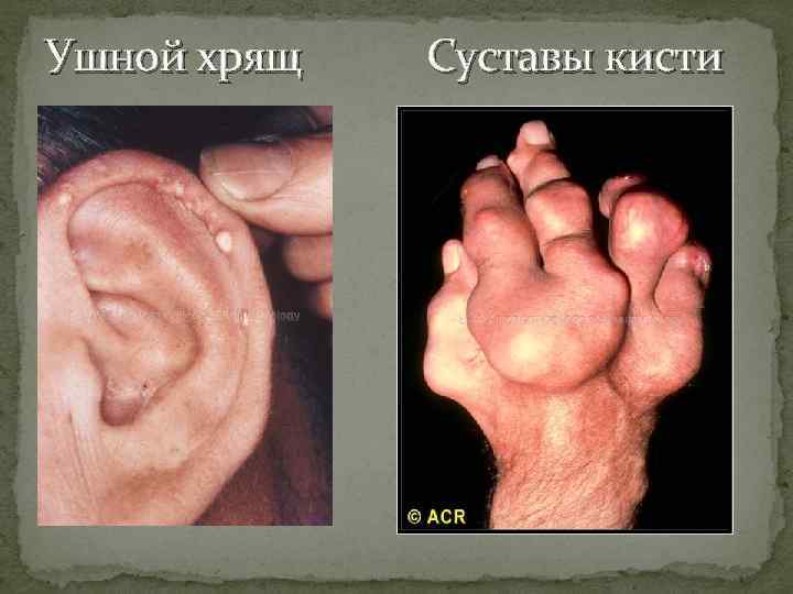Ушной хрящ Суставы кисти 
