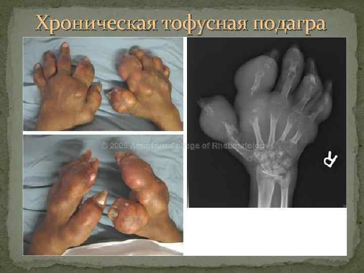Хроническая тофусная подагра 