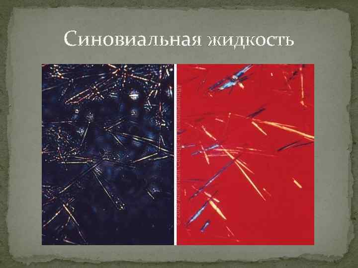 Синовиальная жидкость 