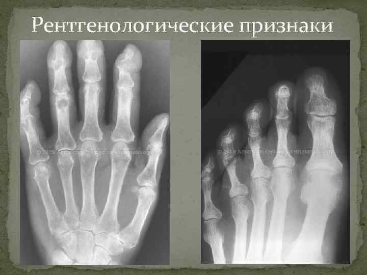 Рентгенологические признаки 
