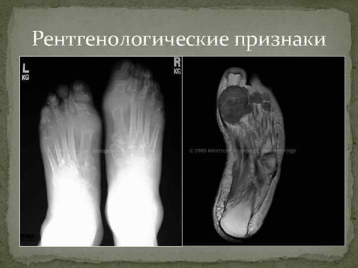 Рентгенологические признаки 