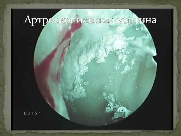 Артроскопическая картина 