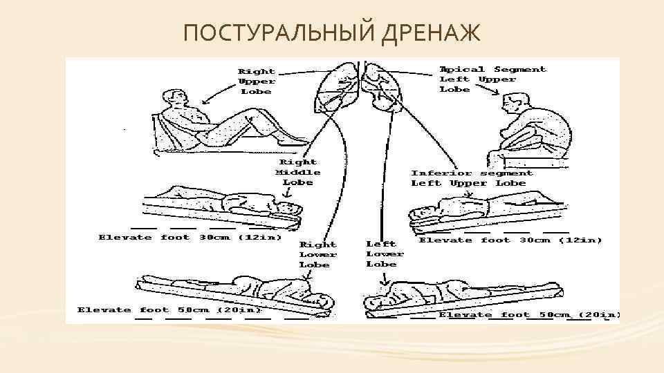 ПОСТУРАЛЬНЫЙ ДРЕНАЖ 