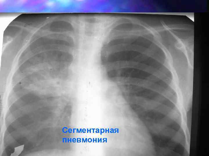 Сегментарная пневмония 
