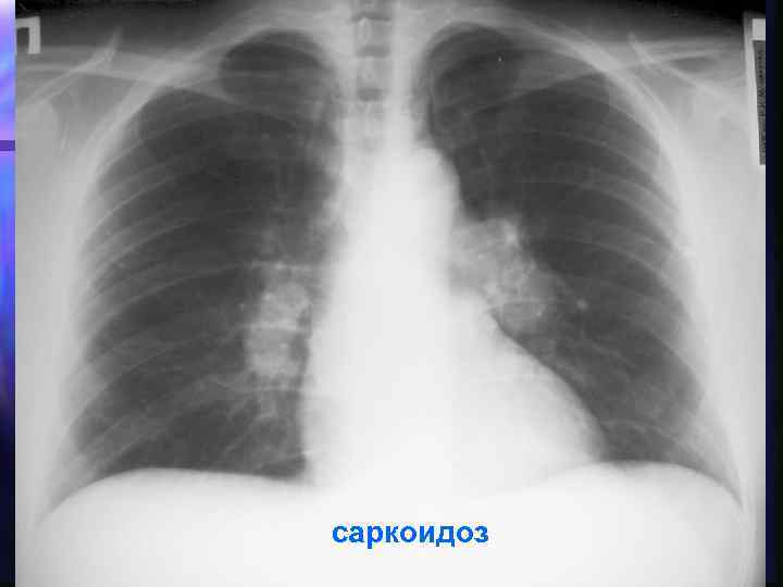 саркоидоз 