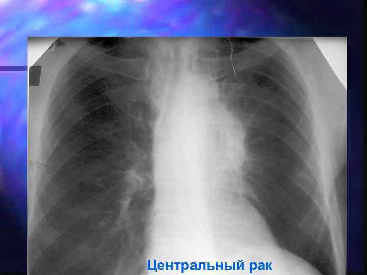 Центральный рак 