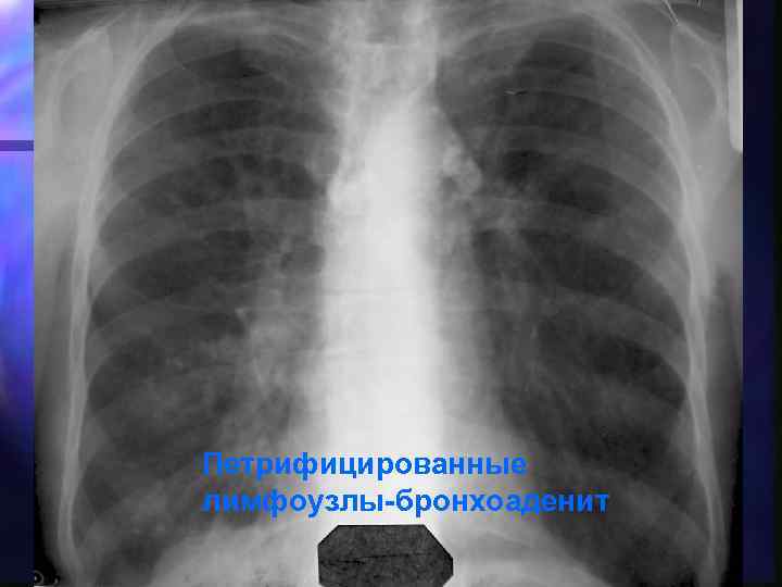 Петрифицированные лимфоузлы-бронхоаденит 