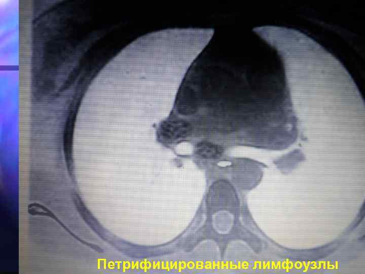 Петрифицированные лимфоузлы 