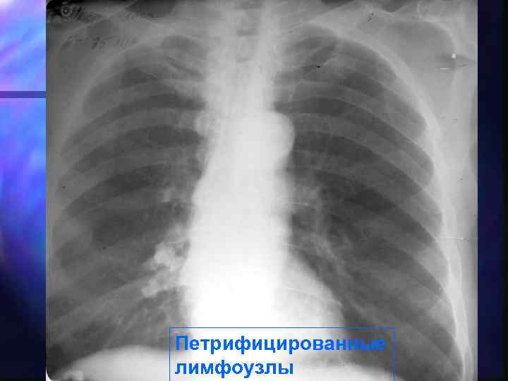 Петрифицированные лимфоузлы 