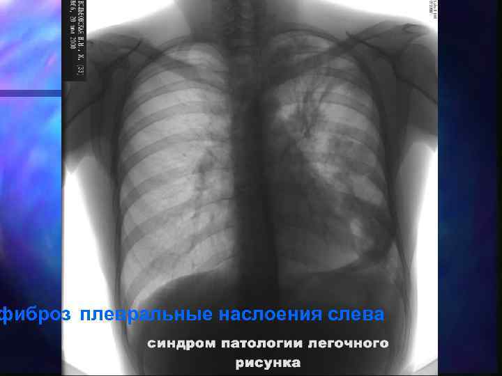фиброз плевральные наслоения слева 